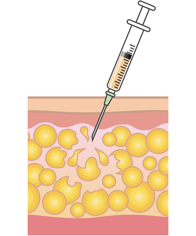 スルリム注射（脂肪破壊/溶解注射）