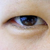 腫れぼったいまぶた