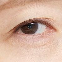 まぶたのたるみ・くぼみ