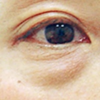 目の下のたるみ・ふくらみ・涙袋