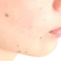 ホクロ・あざ除去