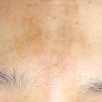 肝斑（かんぱん）