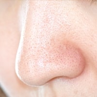 毛穴の開き・黒ずみ