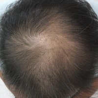 発毛・育毛／AGA治療（男性）