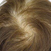 発毛・育毛（女性）