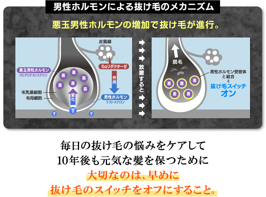 AGA（男性型脱毛症）とは・・・
