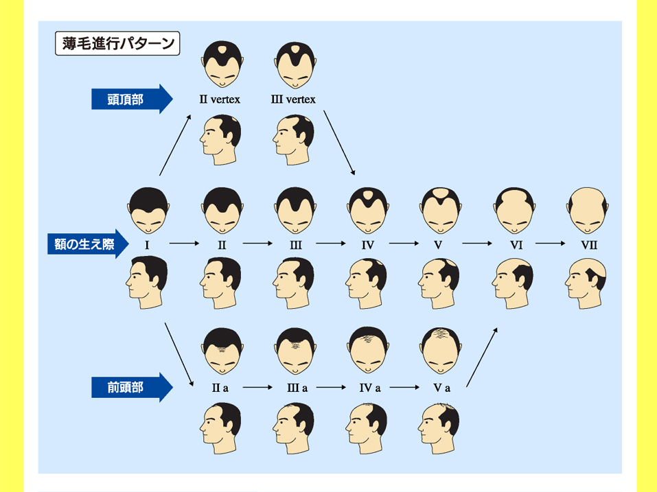 AGA（男性型脱毛症）とは・・・