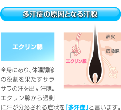 多汗症の原因となる汗腺