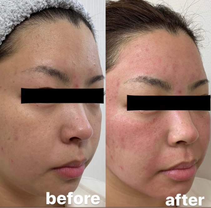 ダーマペン4施術直後の赤みについて | スタッフ・ドクターブログ