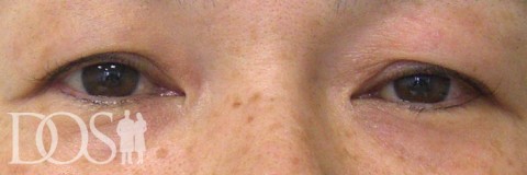 当院患者さま（44歳）：まぶたのタルミ：施術前