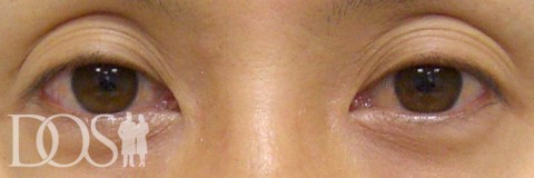 当院患者さま：眼瞼下垂：施術前