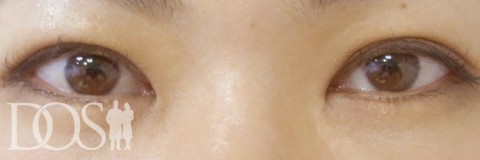 当院患者さま（35歳）：二重形成、目の幅拡大、厚いまぶたの改善：施術後