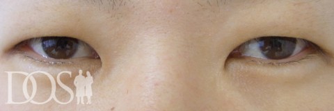 当院患者さま（35歳）：二重形成、目の幅拡大、厚いまぶたの改善：施術前