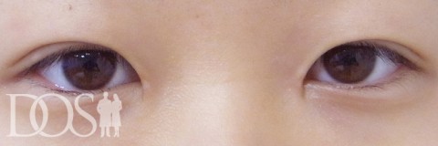 当院患者さま（19歳）：目の幅拡大、二重の幅変更：施術後