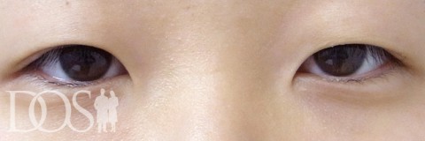 当院患者さま（19歳）：目の幅拡大、二重の幅変更：施術前