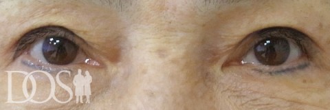 当院患者さま（63歳）：眼瞼下垂：施術後