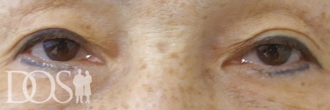 当院患者さま（63歳）：眼瞼下垂：施術前