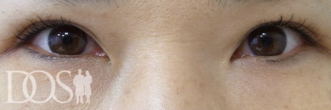 当院患者さま（43歳）：二重形成、厚いまぶたの改善：施術後