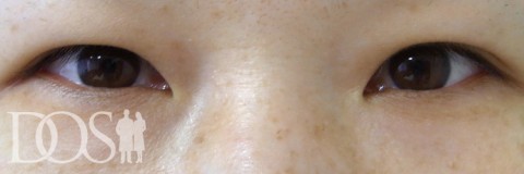 当院患者さま（43歳）：二重形成、厚いまぶたの改善：施術前