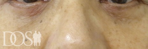 当院患者さま：目の下のたるみ：施術後