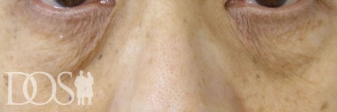 当院患者さま：目の下のたるみ：施術前