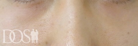 当院患者さま（32歳）：目の下のたるみ：施術後