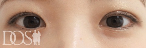 当院患者さま（20代）：二重の幅変更：施術後