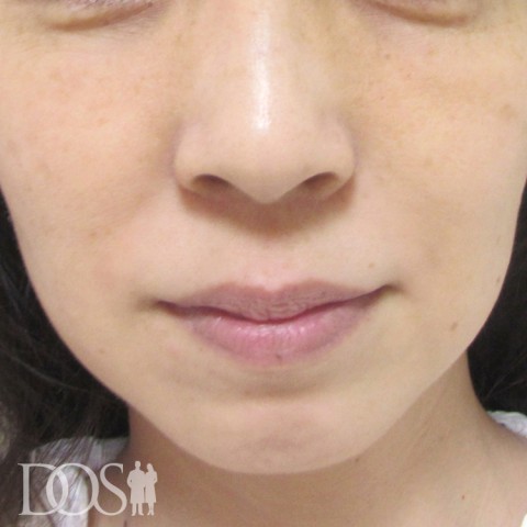 当院患者さま（46歳）：目の下のたるみ、口元のしわ：施術後