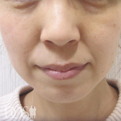 当院患者さま（46歳）：目の下のたるみ、口元のしわ：施術前