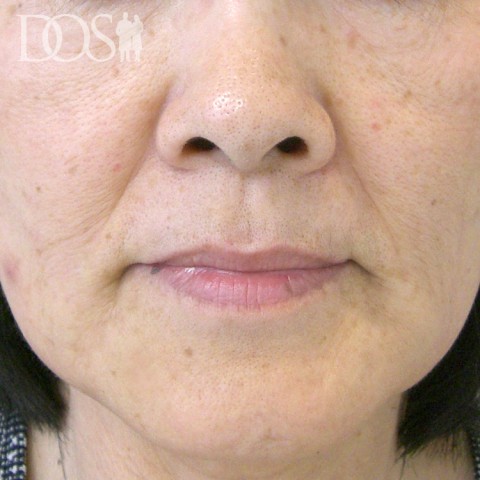当院患者さま（60歳）：ほうれい線：施術後