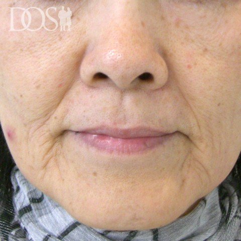 当院患者さま（60歳）：ほうれい線：施術前