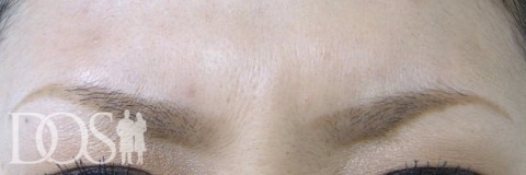 当院患者さま（30歳）：眉間のしわ：施術後