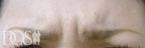 当院患者さま（30歳）：眉間のしわ：施術前