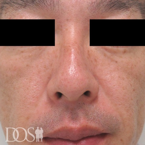 当院患者さま（43歳）：目の下と頬のたるみ：施術後