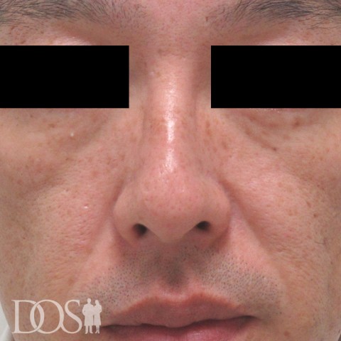 当院患者さま（43歳）：目の下と頬のたるみ：施術前