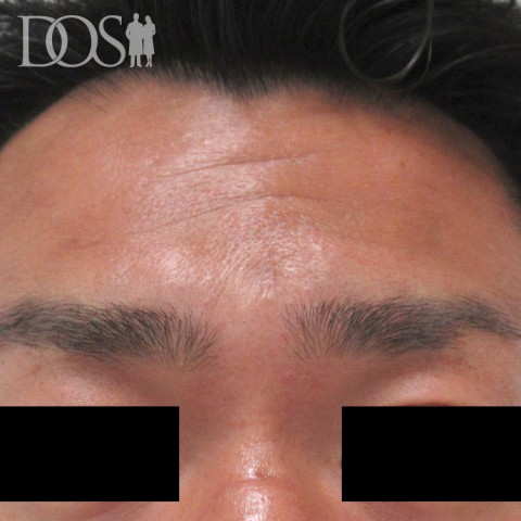 当院患者さま（37歳）：額のしわ：施術後
