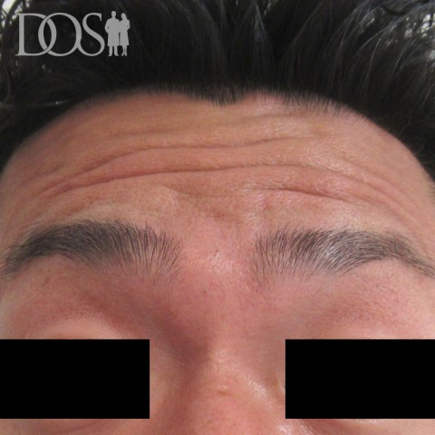 当院患者さま（37歳）：額のしわ：施術前