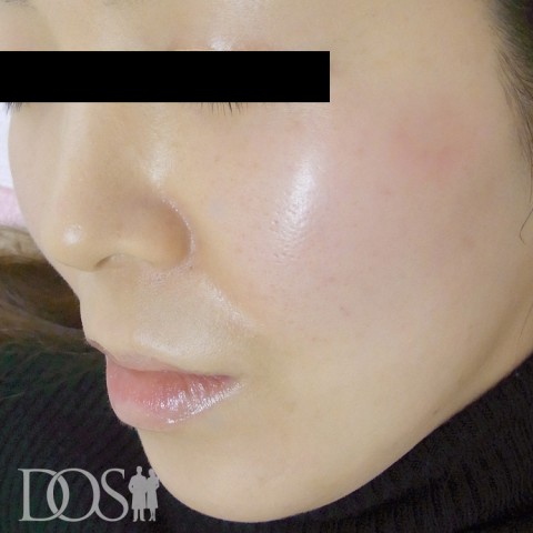 当院患者さま（34歳）：しみ：施術後