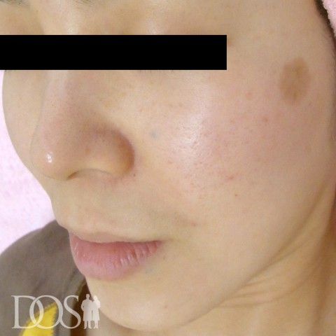 当院患者さま（34歳）：しみ：施術前