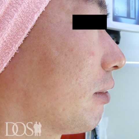 当院患者さま（31歳）：ニキビ・ニキビ痕：施術後