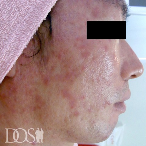 当院患者さま（31歳）：ニキビ・ニキビ痕：施術前