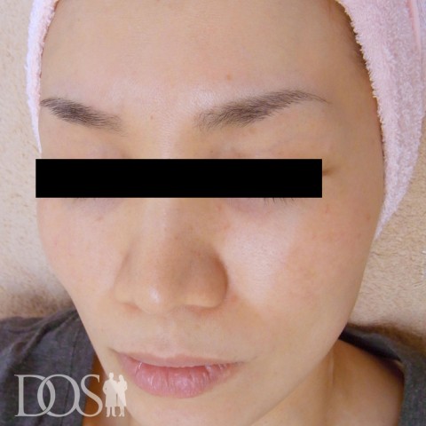 当院患者さま（40歳）：赤ら顔：施術後