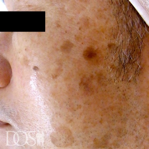 当院患者さま（54歳）：しみ：施術前