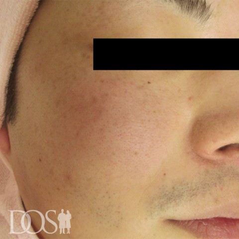 当院患者さま：肝斑：施術後