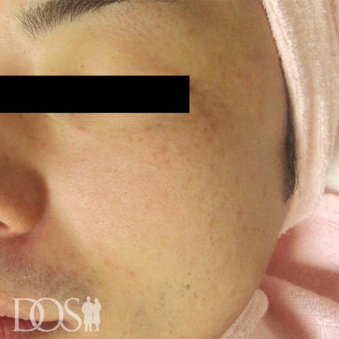 当院患者さま：肝斑の症例写真（after）