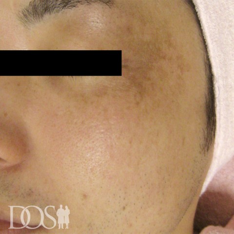 当院患者さま：肝斑の症例写真（before）