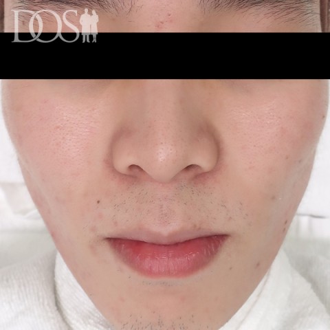 当院患者さま：ニキビ・ニキビ痕（23歳）：施術後