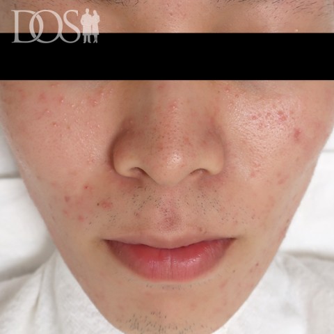 当院患者さま：ニキビ・ニキビ痕（23歳）：施術前