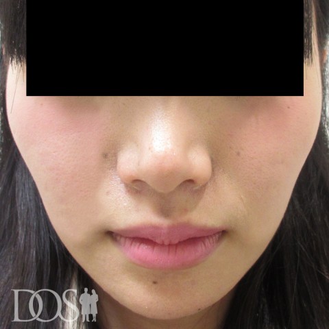 当院患者さま（24歳）：エラ（咬筋）：施術後