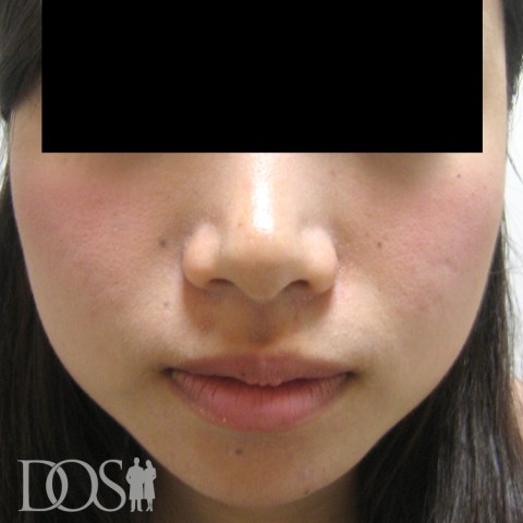 当院患者さま（24歳）：エラ（咬筋）：施術前
